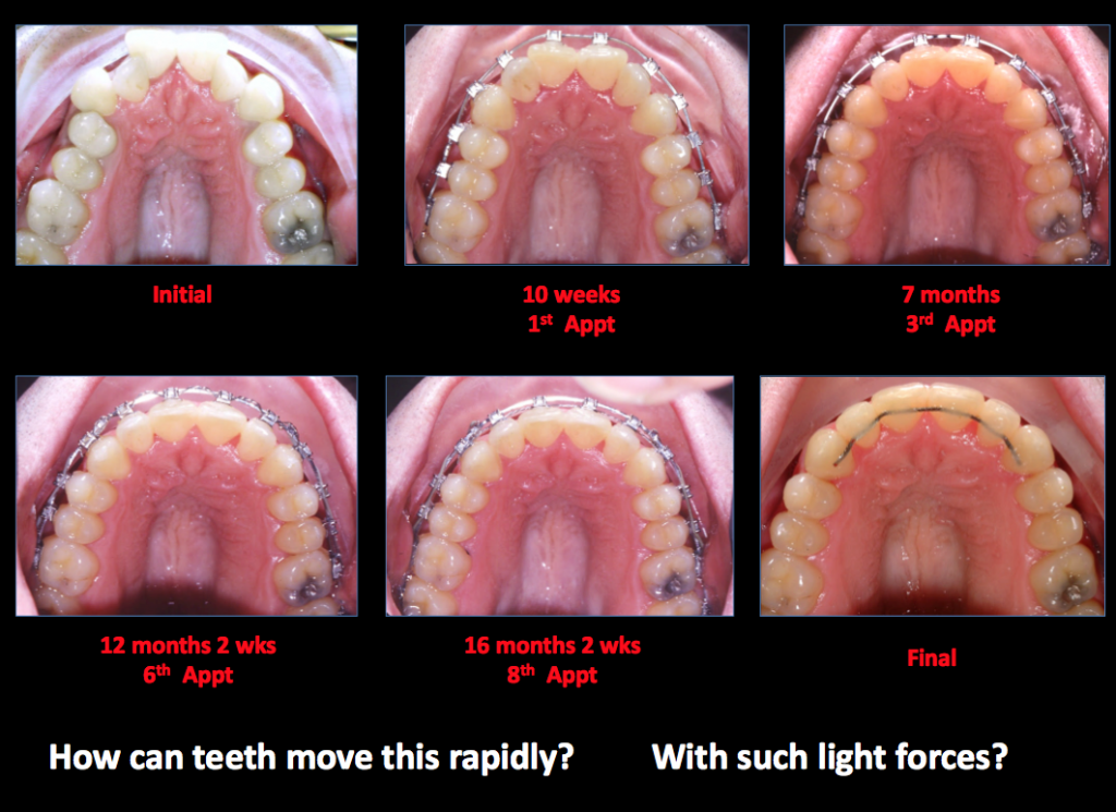 Expansion Of Upper Jaw With Damon Braces The Park Dental Clinic